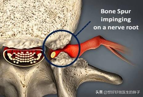 专家教你如何防治腰椎间盘突出症,腰椎间盘突出和腰突有什么关系