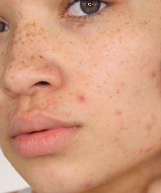 痘痘反反复复又红又疼又痒,痘痘反反复复有一层皮