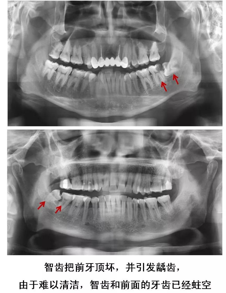 Helen齿科中心——智齿是不是非拔不可？