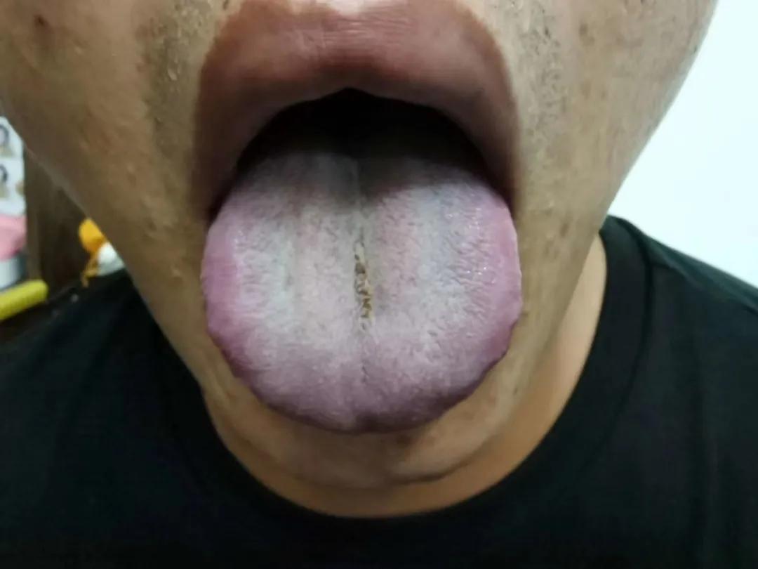 中医治左膝关节不能打弯,左膝伸不直