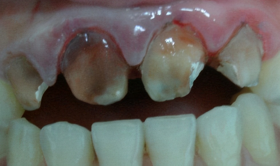 有多少人做了烤瓷牙后悔呀,为什么越来越多人放弃烤瓷牙