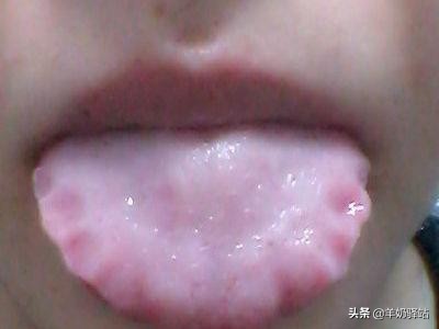 什么样的舌苔是清热祛湿好了,舌苔黄腻的人应注意什么