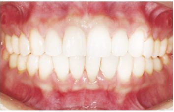 满口缺牙如何补牙,满口缺牙怎么办