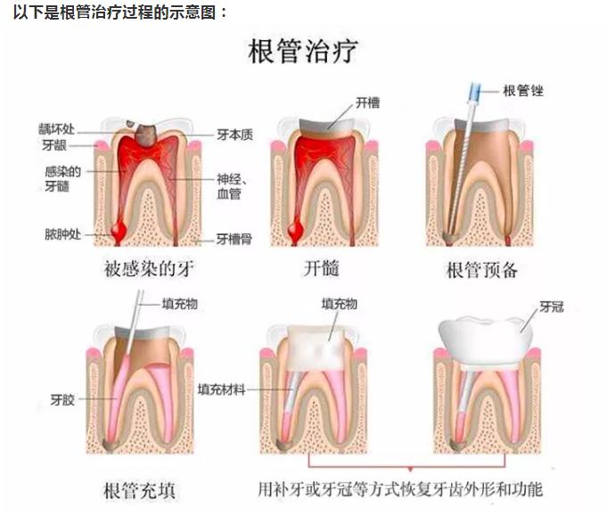 根管治疗是牙的什么问题,根管治疗真的是无法承受之痛吗