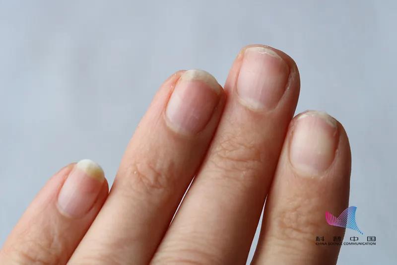 指甲有很小的黑色竖纹怎么回事,脚趾甲变黄变厚有竖纹是咋回事