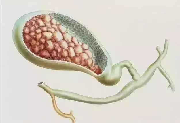 食疗胆结石的有效方法,胆结石术后营养食谱大全