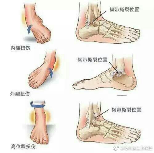 脚扭伤了注意安全,脚关节扭伤留下后遗症怎么解决