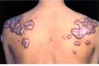 耳垂长个肉疙瘩是怎么回事,耳垂肉长了硬疙瘩怎么回事