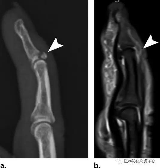 手腕撕脱性骨折一年了还隐隐作痛,手腕三角骨撕脱骨折症状有哪些