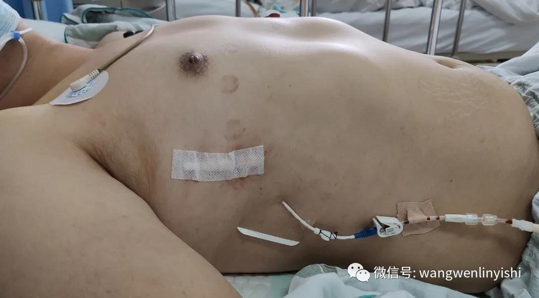 胸围超1米：重度桶状胸，Wenlin手术