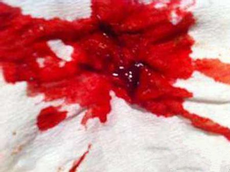 年纪大比较容易宫外孕,大学意外宫外孕