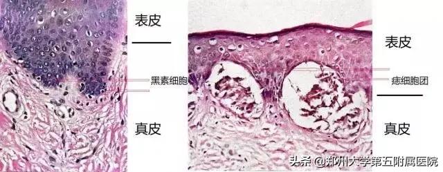 点痣哪种情况说明没掉,点痣一般用什么点比较好