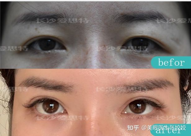 埋线双眼皮两边不对称怎么办,埋线双眼皮不对称修复方法