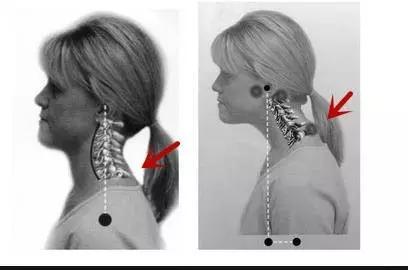 路医生说丨脖子后面的“富贵包”，是肿瘤么？真的会瘫痪夺命么？