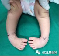 马蹄内翻足孩子的康复,成人马蹄足内翻康复治疗