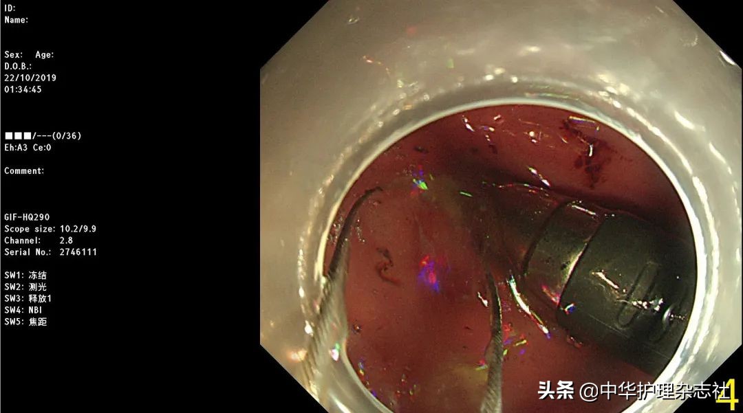 误吸患者护理的应急预案,幼童误吞电池医生顺利取出