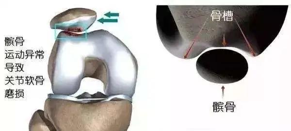 膝盖走路老是打弯是缺钙么,走路膝盖咯噔咯噔响是缺钙吗