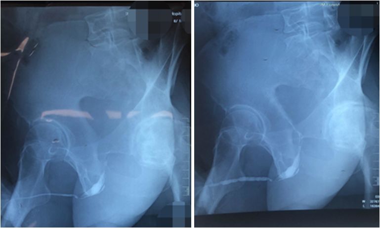 男性炎症性尿道狭窄,皮肤苔藓硬化致尿道口狭窄