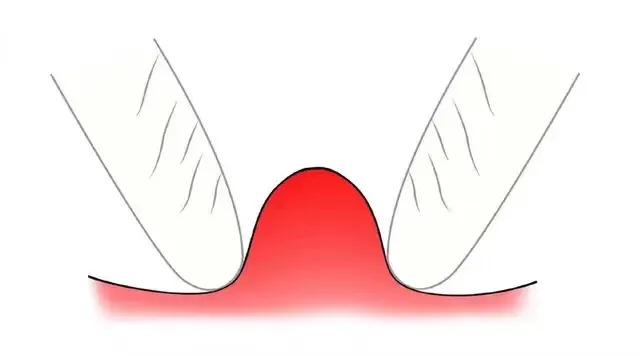 挤痘痘挤到一半就挤不出来了,痘痘挤破了怎么快速消痘