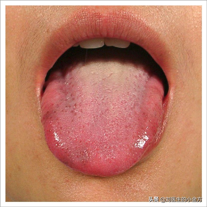 舌象图解大全中医舌诊,最全中医舌诊图谱来了