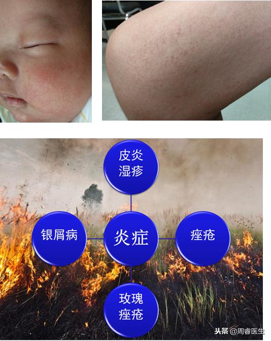 角化湿疹变硬的皮肤怎么恢复,擦湿疹药膏后皮肤变白会恢复吗