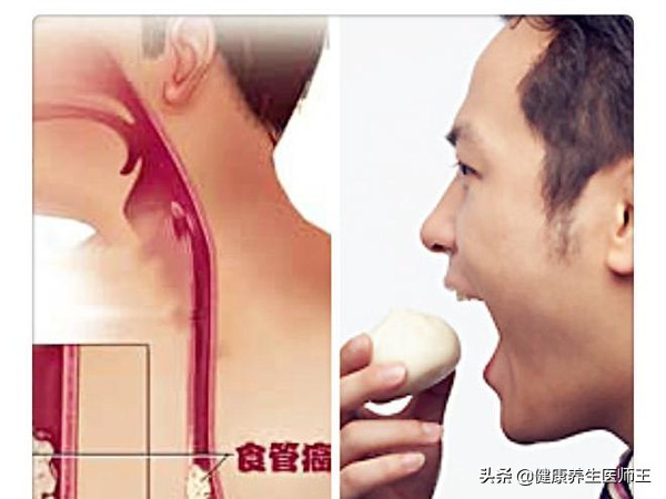 食管癌四期化疗能延长多久生命,食管癌手术后健康宣教