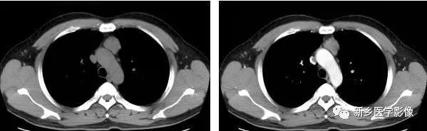 胸腺增生和纵隔肿瘤的区别和症状,纵隔胸腺肿瘤的常见临床症状表现
