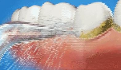 刷牙姿势不对导致补牙,刷牙姿势不对导致牙龈有裂痕