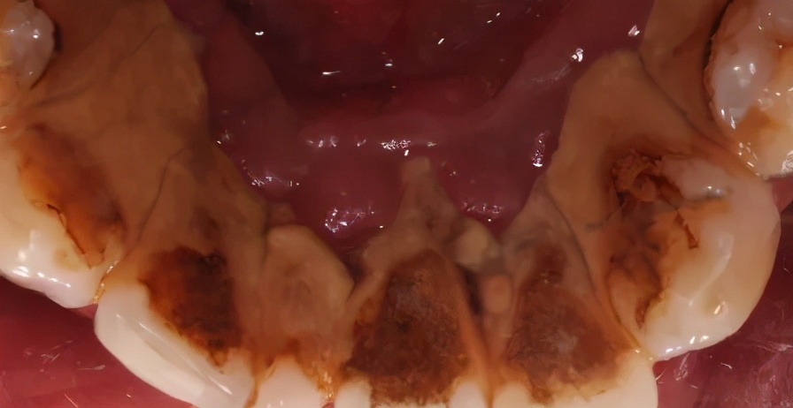 牙结石是每个人都会有的吗,牙结石是每个人都会有的嘛