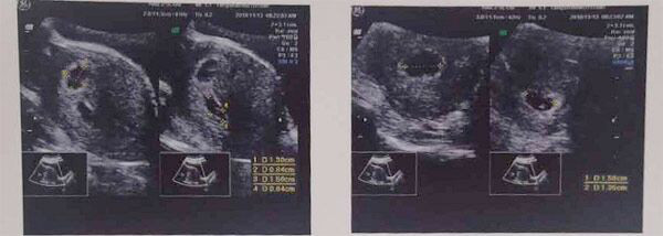 好“孕”降临：多年不孕夫妇到河北唐山宝岛妇儿医院来报喜