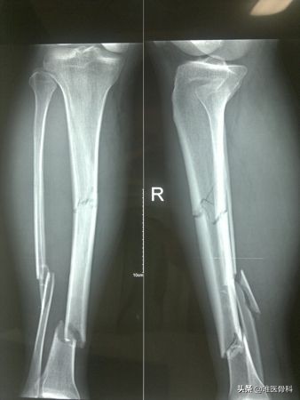 摔断腿骨头后期修复,摔断腿骨头多久能恢复