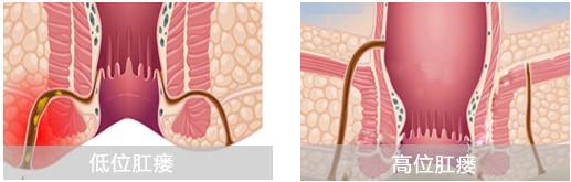 肛周脓肿流脓后中药能治愈吗,肛周肿痛伴破溃流脓1周