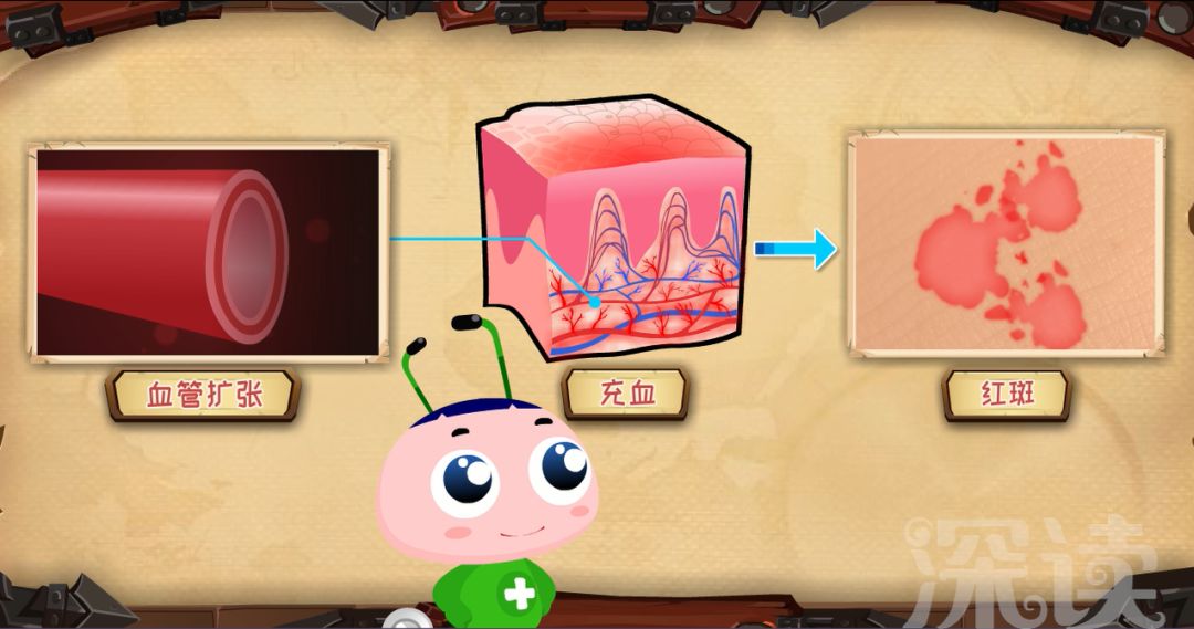 银屑病为什么会有鳞屑脱落,皮屑好治吗