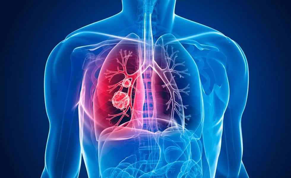 肺癌靶向药吉非替尼多少钱,西方不亮的东方亮