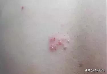 孩子出水痘怎么办最快最有效,小孩出水痘要怎么处理