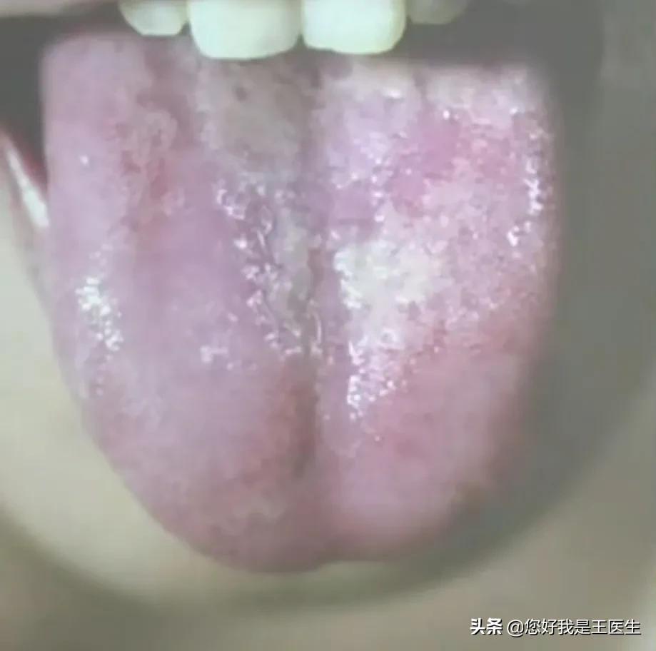 舌苔黄腻用生薏苡仁还是炒薏苡仁,舌苔厚腻祛湿没有效果