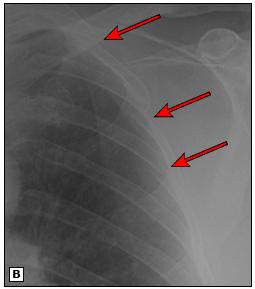 外卖小哥逆行被撞成手臂骨折,逆行的外卖小哥撞到我怎么办