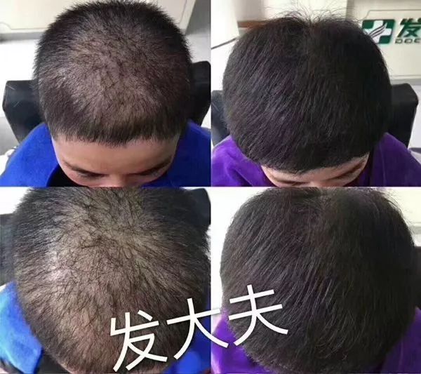 专家推荐治疗脱发白发食疗药酒,中医调理白发脱发养发