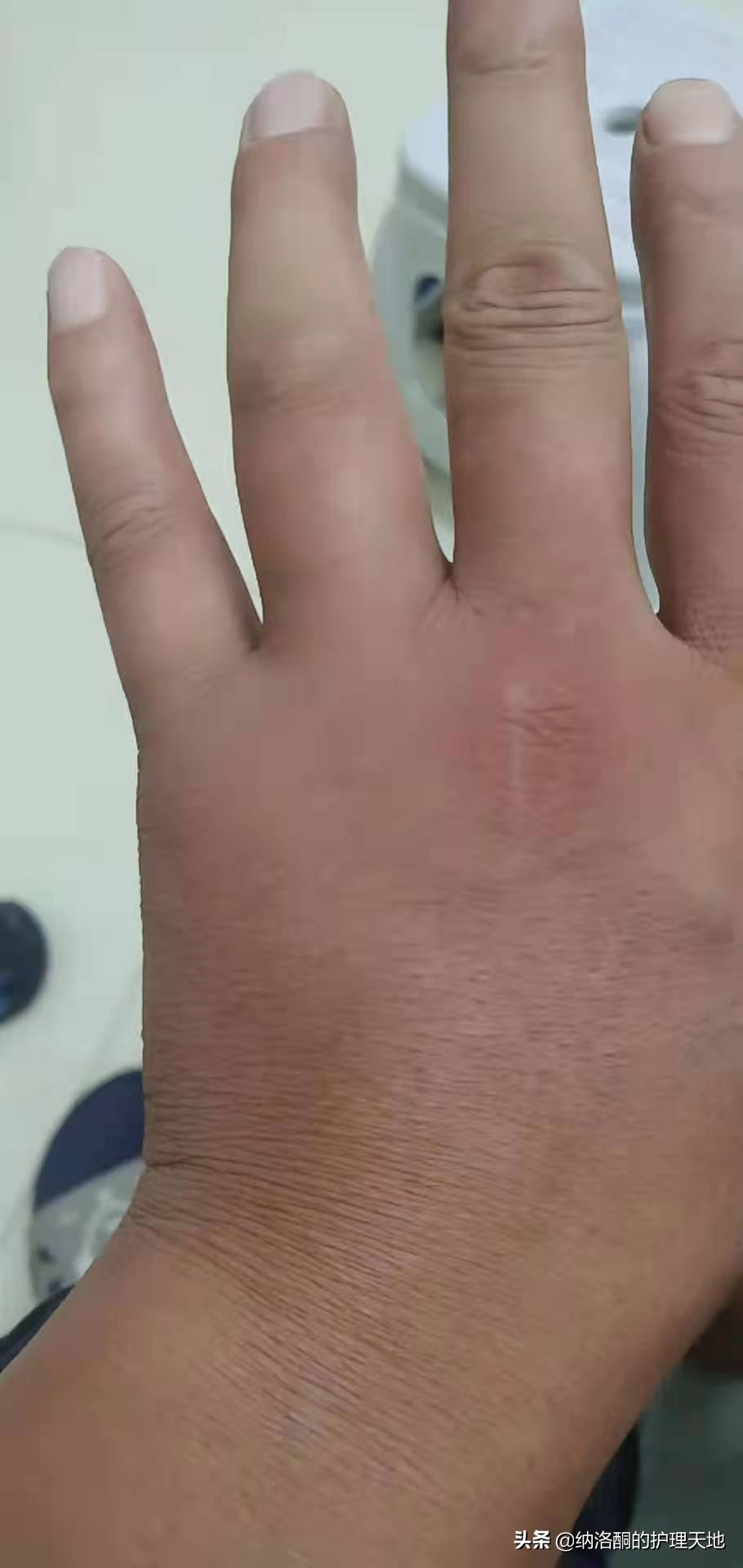 被金环胡蜂咬了肿了在家怎么办,被金环虎头蜂蛰了如何止疼