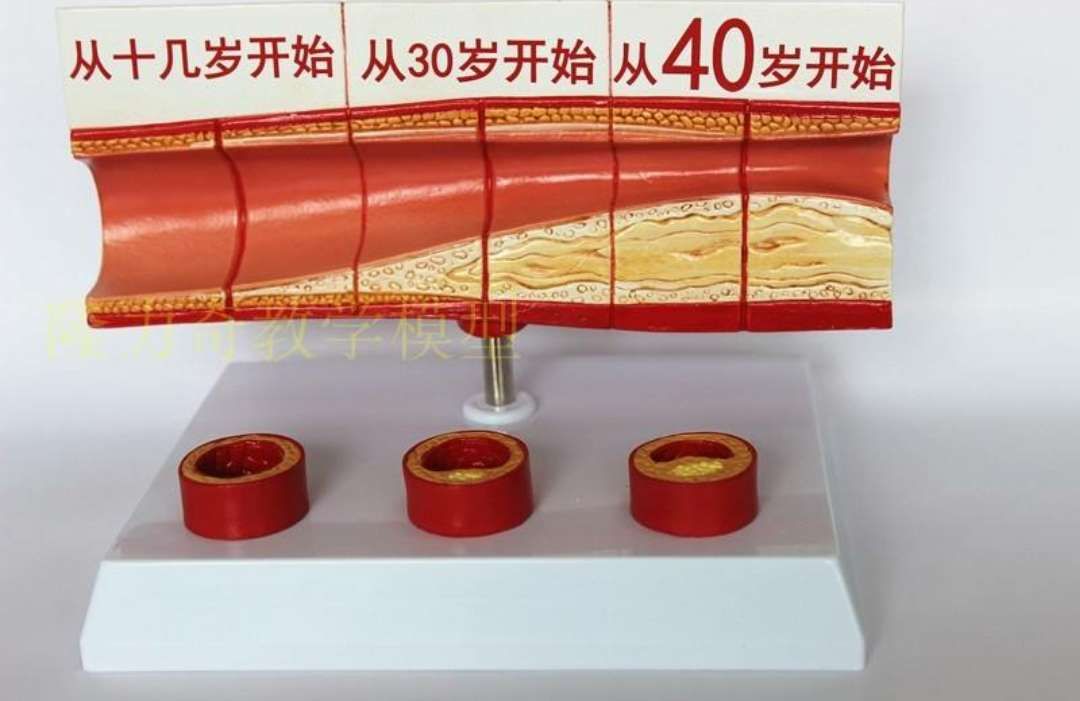 去除血栓最好的治疗办法,得了血栓怎么有效的去除