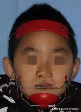 牙齿矫正地包天多久能看到效果,地包天越早矫正越好吗