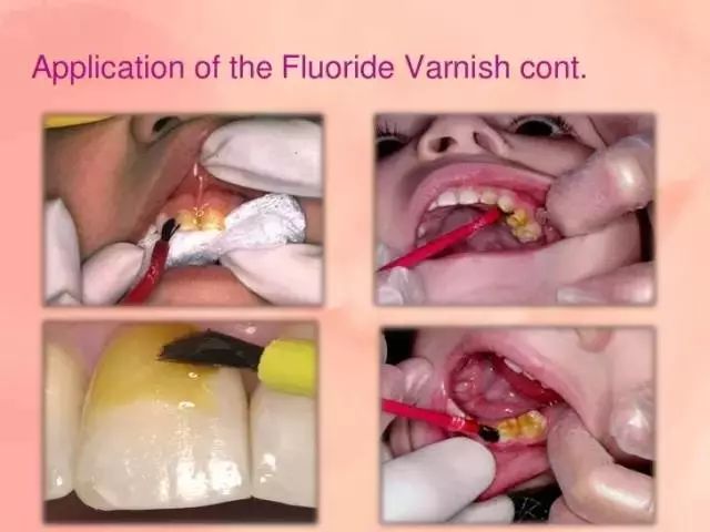 牙齿脱矿白斑怎么修复,牙医修复牙齿漏洞蛀牙全过程