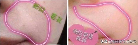 水光针面膜真的有用吗,打水光针为什么要面膜