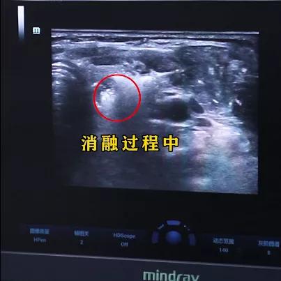 桥本甲亢和结节,桥本甲状腺炎出现轻微甲亢