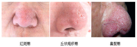 这令人烦心的酒糟鼻到底该如何应对？