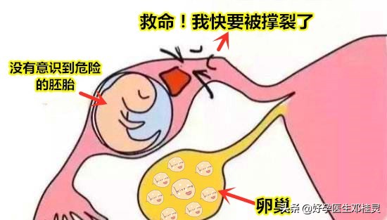 3次宫外孕保守治疗,宫外孕3次怎么办