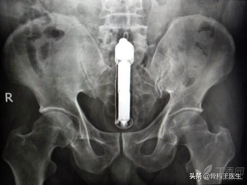 医院取出的异物怎么处理,医生都从患者体内取出过什么异物