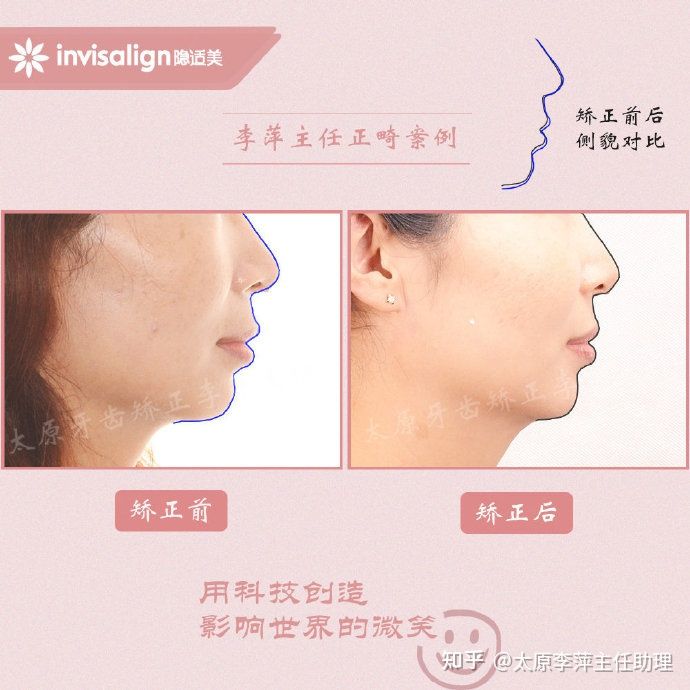 太原牙齿矫正靠谱吗,太原成人隐形牙套牙齿不齐