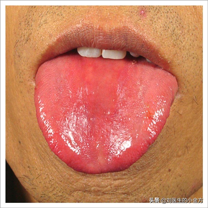 舌象图解大全中医舌诊,最全中医舌诊图谱来了