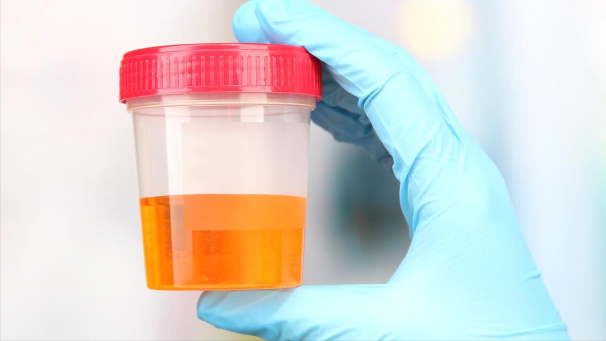 导致尿黄的各种原因,解小便感到小便烫是什么原因